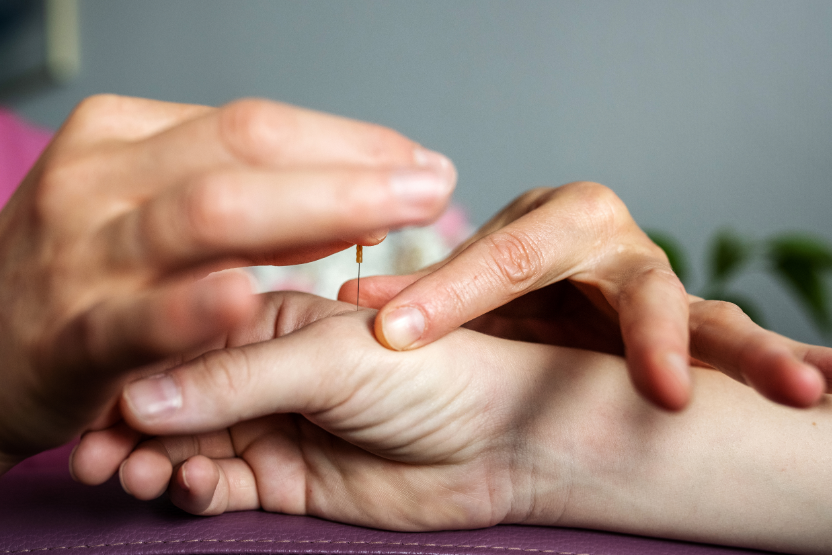 Acupuncture practitioner's hands placing a needle in a patient's hand.